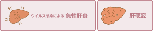 ウイルス感染による急性肝炎、肝硬変